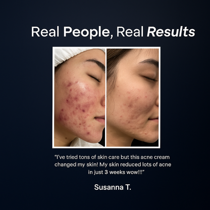 BaeClear® Acne Cream