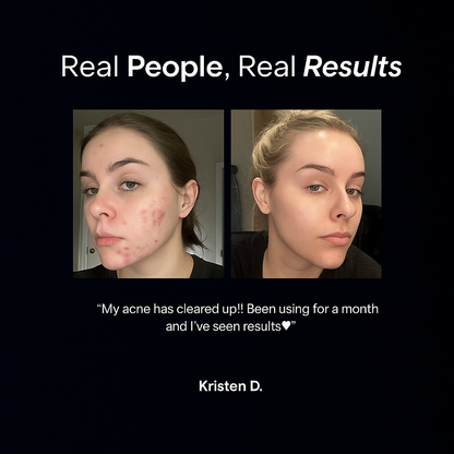 BaeClear® Acne Cream