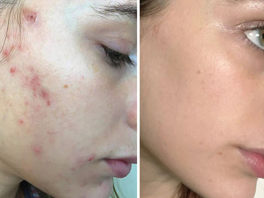 files/acne_scars_before_and_after.webp